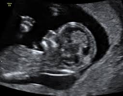The amount of fluid is measured during an nt ultrasound scan: 12 Weeks Nt Scan Between Two Evils