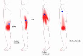 positive health online article treating trigger points