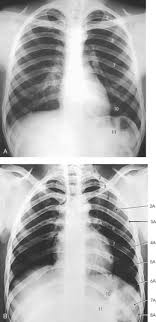 The rib cage protects the organs in the thoracic cavity, assists in respiration, and provides support for. Bony Thorax Radiology Key