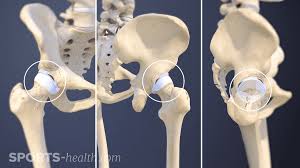 Image result for Hip Labral Tear