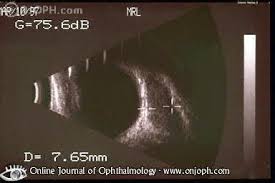 The reason is that small, nonpalpable ultrasound abnormalities are very common in people without evidence of thyroid disease. Atlas Of Ophthalmology