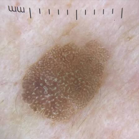Dermatoscopia da queratose seborreica em três padrões: cerebriforme, em  impressão digital e fat fingers. #dermoscopy #dl4 #dl5 #dermlite  #seborrheickeratosis #dermatology #dermatologia #queratoseseborreica