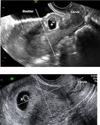 Image result for First Trimester Ultrasound