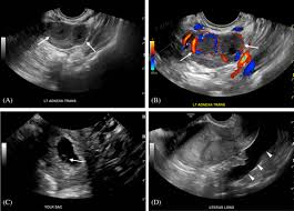 Image result for corpus luteum sonography)