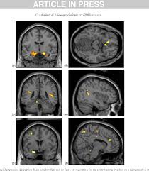 How common is savant syndrome? Figure 2 From Differential Activation Of The Amygdala And The Social Brain During Fearful Face Processing In Asperger Syndrome Semantic Scholar