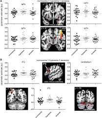 Image result for Drug-Induced Olfactory Dysfunction