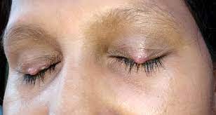 Feb 17, 2021 · by ernie mundell and robert preidt healthday reporters. Community Eye Health Journal Telemedicine In Ophthalmology During Covid 19 Pandemic
