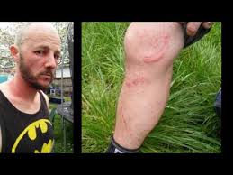 Image result for Rhus Dermatitis