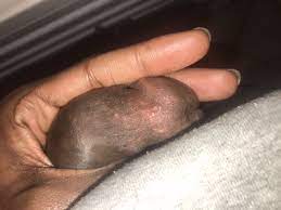 Tyson Glands!?!? Should I Be Worried? | Penis Disorders | Forums | Patient