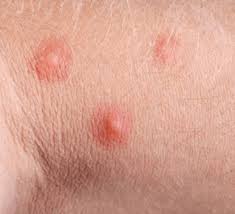 This is a common form of physical urticaria where hives form after firmly stroking or scratching the skin. Hives Walk In Dermatology