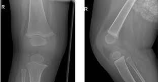 Image result for Knee XRay