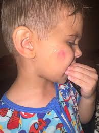 Booboo salve for scraped cheek