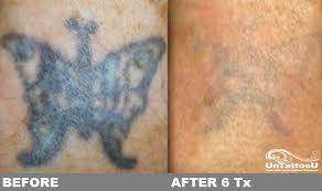 Untattoou Laser Tattoo Removal Before After 6 Treatments Lasertattooremoval Tattooremoval Picosure U Laser Tattoo Tattoo Removal Cream Tattoo Removal