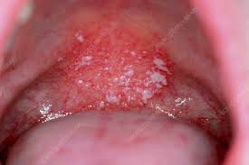 Image result for Oral thrush roof of mouth
