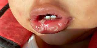 Jamur ini menular dari lingkungan ke seseorang, namun tidak menular dari orang ke orang. Ini Obat Sariawan Bayi Di Apotik Yang Aman Dan Ampuh