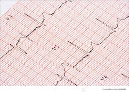 Health A Closeup Of A Chart Showing An Ekg Printout