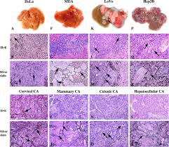 The lymph nodes, bones, liver, lungs, and brain. Xenograft Models For Liver Metastasis Relationship Between Tumor Morphology And Adenovirus Vector Transduction Molecular Therapy
