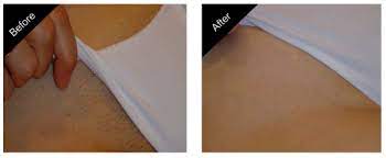 For many people, repetitive shaving, waxing during this treatment at hamilton facial plastic surgery, located in carmel and greenwood, indiana, gentle laser energy disables the hair follicles. Laser Hair Removal Carmel Body Hair Removal The New You Esthetics