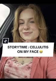 MRSA and Cellulitis: A Nurse's Storytime Experience