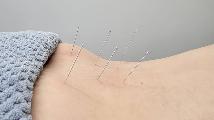 Acupuncture needles and treatment tools at Profrea clinic