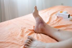 Image result for ant bite