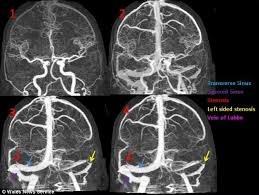 I am 68 years old. Pulsatile Tinnitus And Adderall