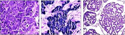 Treatment becomes more difficult as the tumor. Merkel Cell Carcinoma Treatment Pdq Pdq Cancer Information Summaries Ncbi Bookshelf