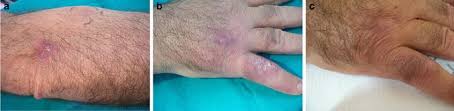 We did not find results for: Lymphocutaneous Sporotrichosis In An Immunocompetent Patient A Case Report From Extreme Southern Italy Springerlink