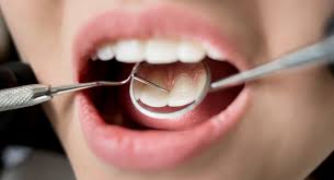 Mouth cancer is a general term for any one of the oral cancers that effect the lips, tongue, inside the mouth, throat, or the cheeks. The Oral Health Foundation Launches National Mouth Cancer Campaign