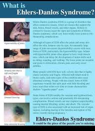 Image result for Hypermobility Signs