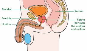 Fistulas are usually the result of an injury or surgery. What Is A Fistula Signs And Symptoms Macmillan Cancer Support