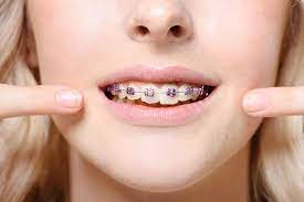 Braces Pain Relief | Andrew W. Skorobatckyj, Dds | Parma, Oh