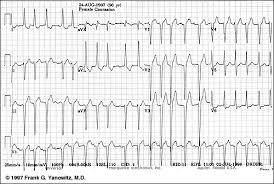 Ecg Learning Center An Introduction To Clinical Electrocardiography P Wave Learning Centers Tutorial Sites