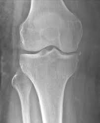 Image result for Segond Fracture