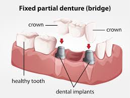 Maybe you would like to learn more about one of these? Dental Bridge Cost Break Down Procedure And Problems Los Angeles Ca