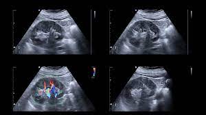 Medical kidney is niche area in pathology. End Stage Renal Disease Symptoms Life Expectancy And More