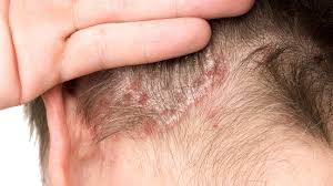 Image result for dry scabs on the head in children