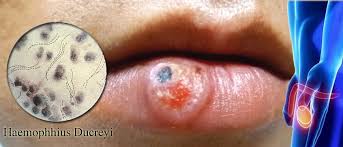 Image result for chancroid