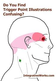 Do You Find Trigger Point Illustrations Confusing Integrative Works Trigger Points Headache Integrative