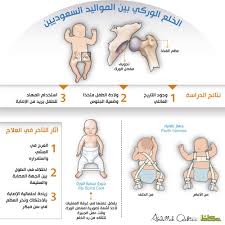 عالجوا الخلع الولادي بالفحص المبكر أخبار السعودية صحيفة عكاظ
