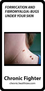 Formication And Fibromyalgia Bugs Under Your Skin Fibromyalgia Fibromyalgia Causes Fibromyalgia Medication
