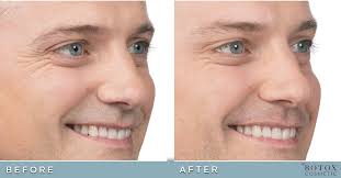 See more from patient 8780. Botox Before And After Pictures Cosmetic Dermatology Knoxville Tn