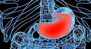 Stomach (gastric) cancer develops from the stomach lining. The Risks Of Untreated Heartburn And Gerd