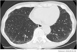 Pendahuluan kanker paru merupakan salah satu penyakit penyebab kematian tertinggi di dunia. Novelties In Imaging In Pulmonary Fibrosis And Nodules A Narrative Review Pulmonology