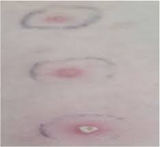 Image result for Pathergy