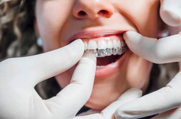 Aligners product image