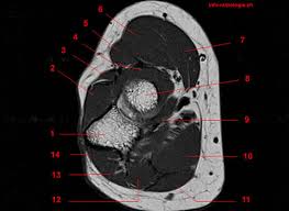In conclusion, quantification of foot muscles enables an objective measure of motor dysfunction closely related to the severity of diabetic neuropathy. Mri Of The Elbow Detailed Anatomy W Radiology