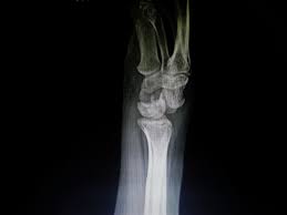 Image result for Scapholunate Dislocation