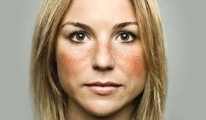 Antibody found in lupus may protect against certain cancers