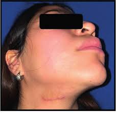 Image result for Sialoadenitis